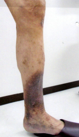 【下肢静脈瘤の初期症状について】 5 【下肢静脈瘤の初期症状について】