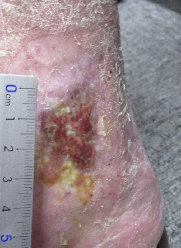 【下肢静脈瘤の初期症状について】 6 【下肢静脈瘤の初期症状について】