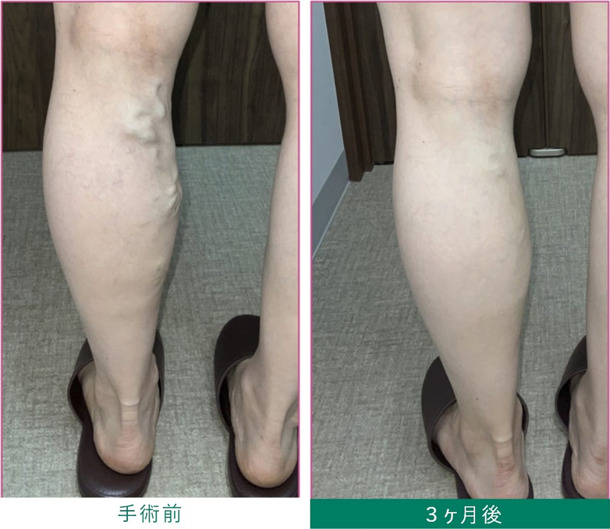 医療用接着剤治療 手術前・3ヶ月後