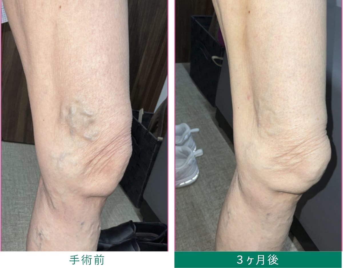 血管内高周波カテーテル治療 手術前・3ヶ月後