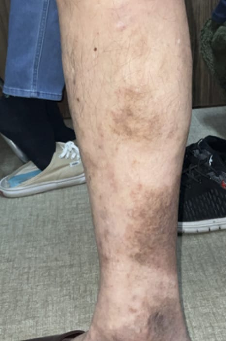 レーザー治療 3ヶ月後