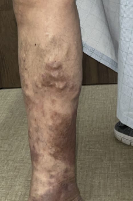 レーザー治療 手術前