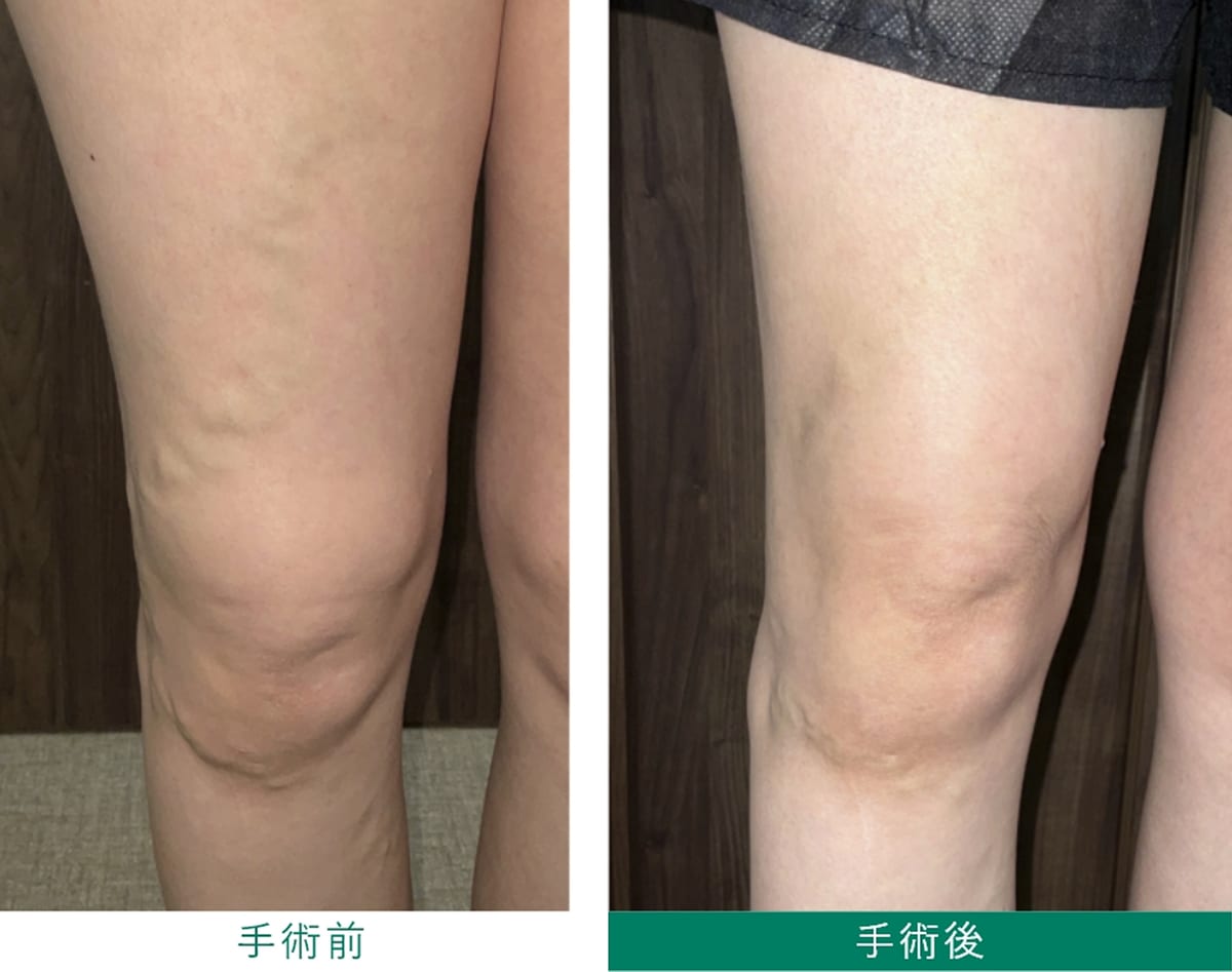 レーザー治療 手術前・手術後