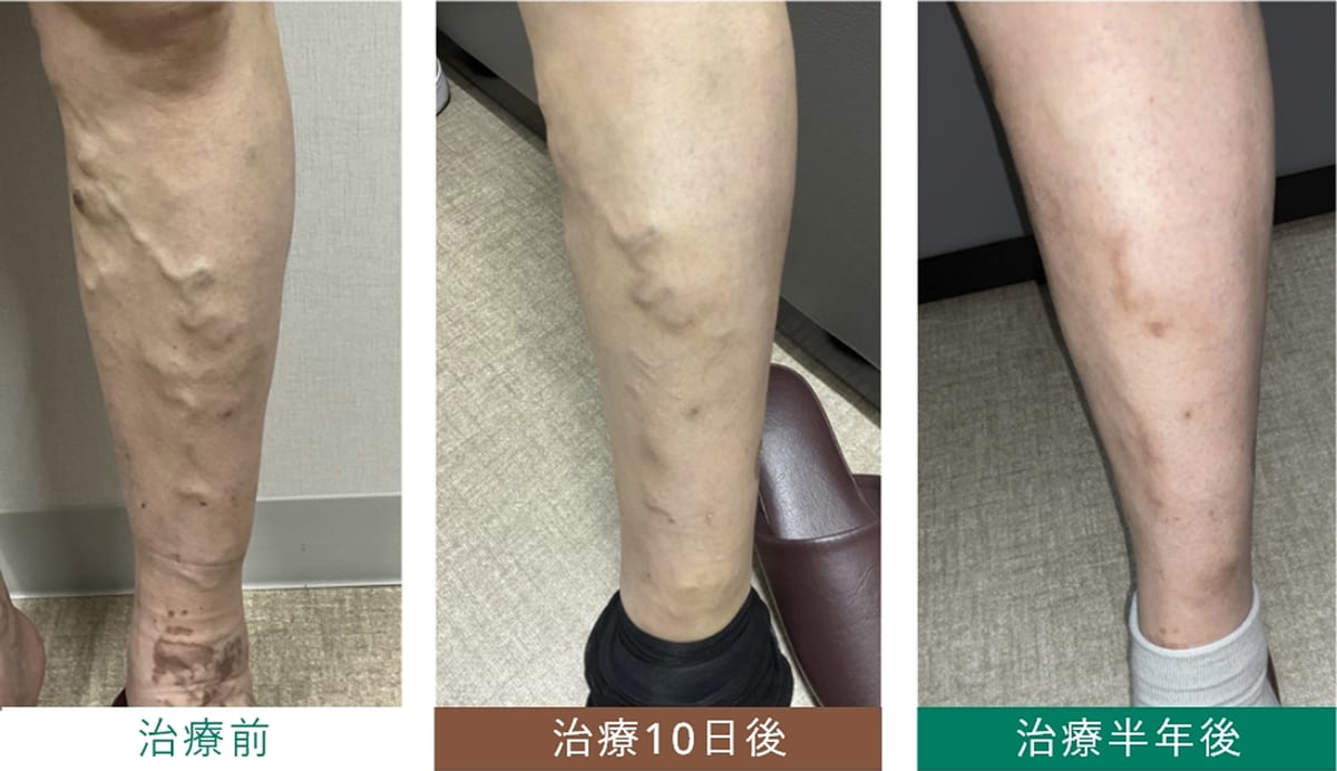 硬化療法 治療経過