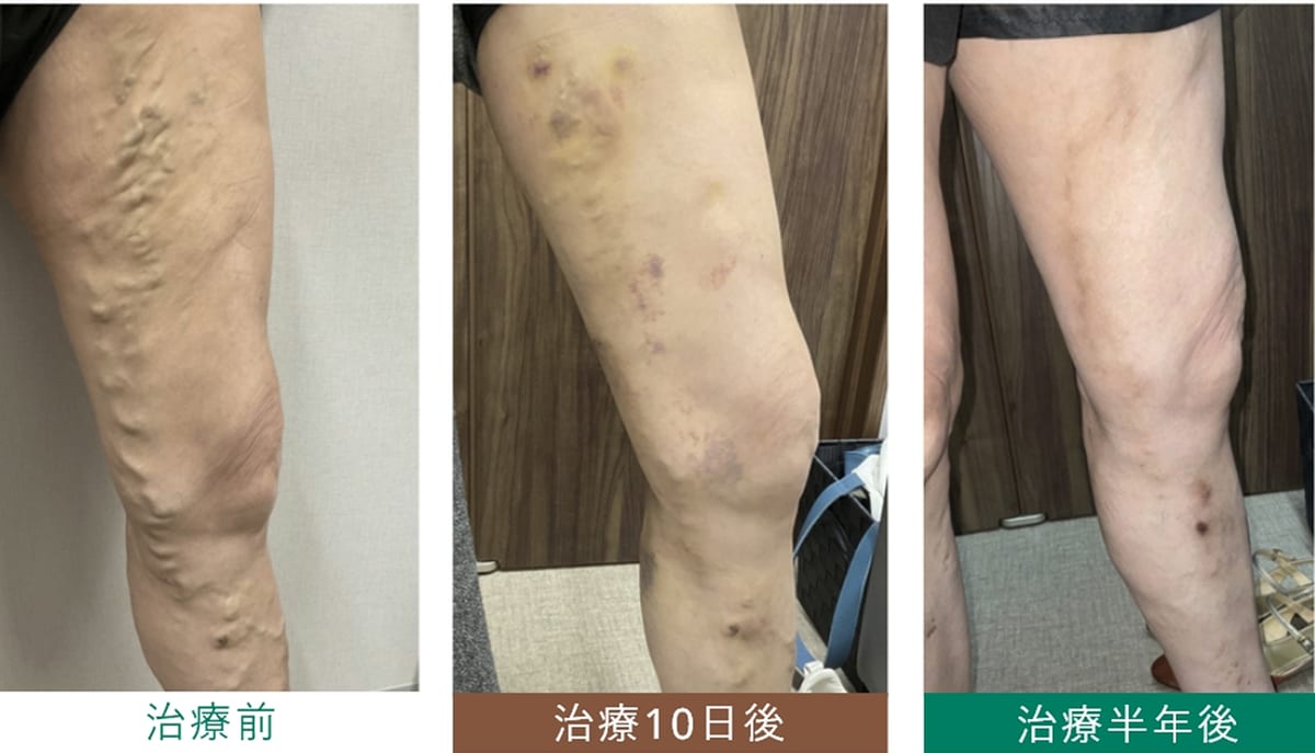 硬化療法 治療経過