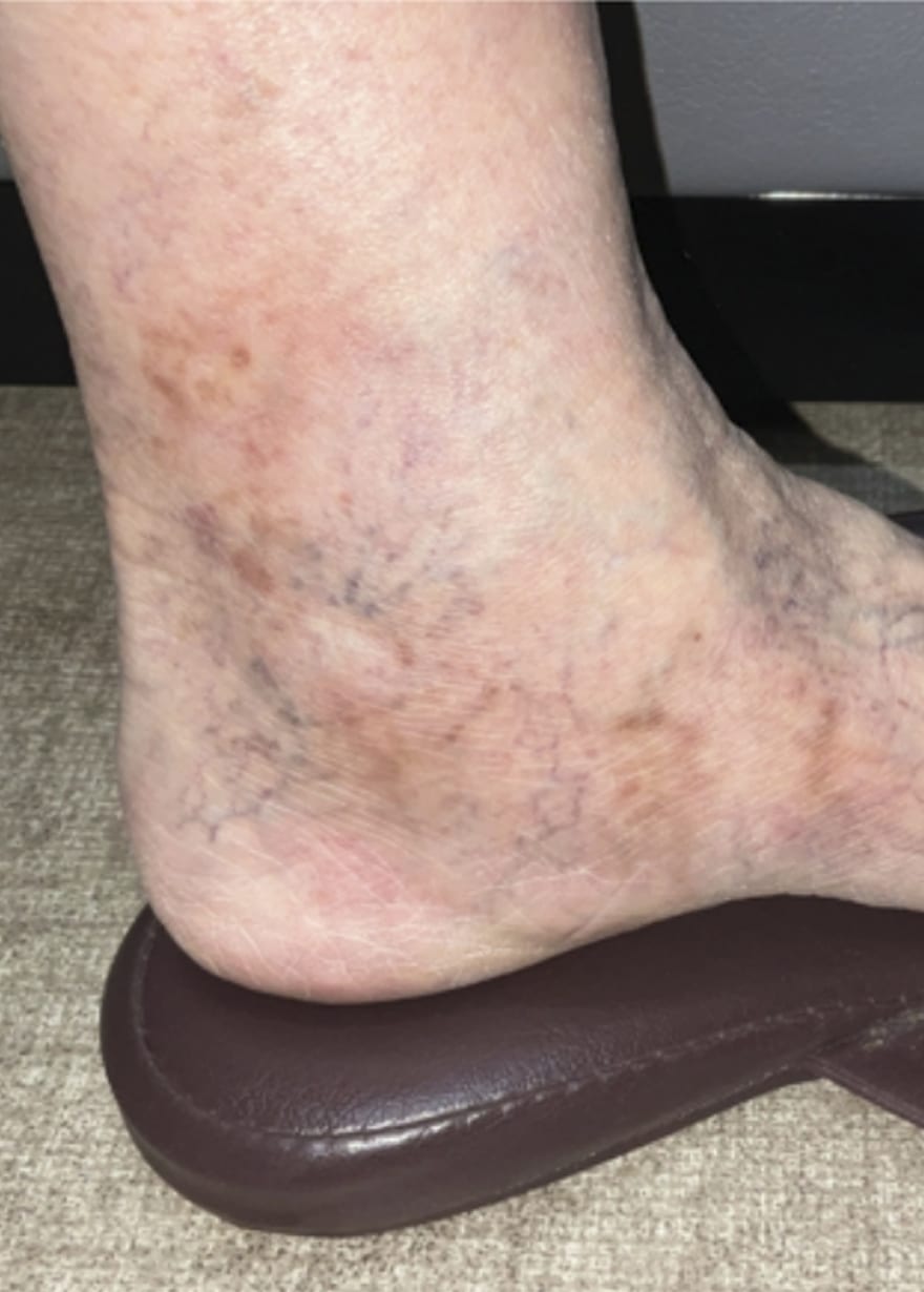 YAGレーザー 半年後