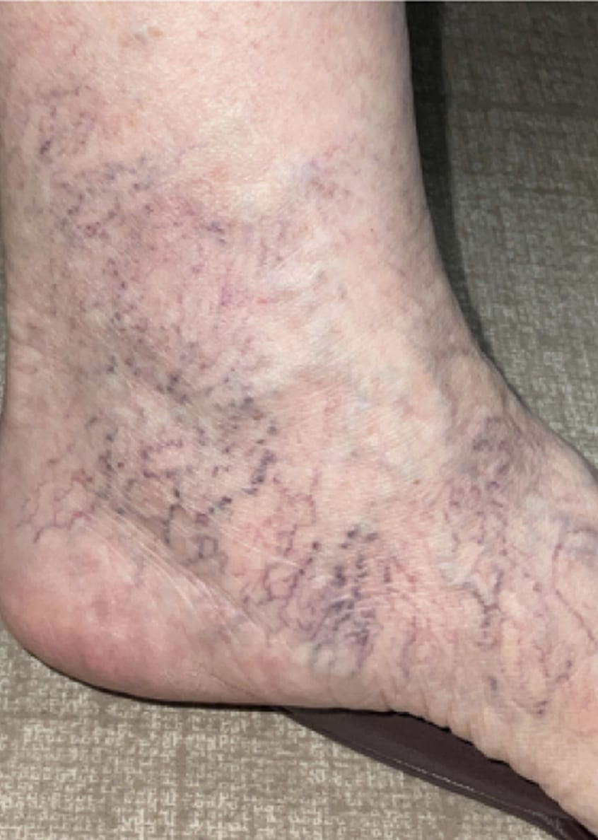 YAGレーザー 治療前