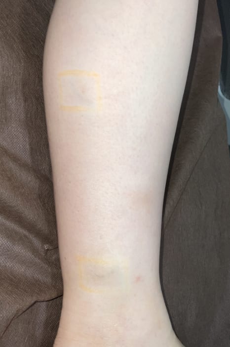 YAGレーザー 10ヶ月後