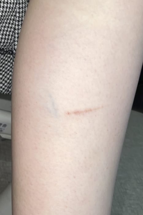 YAGレーザー 治療前