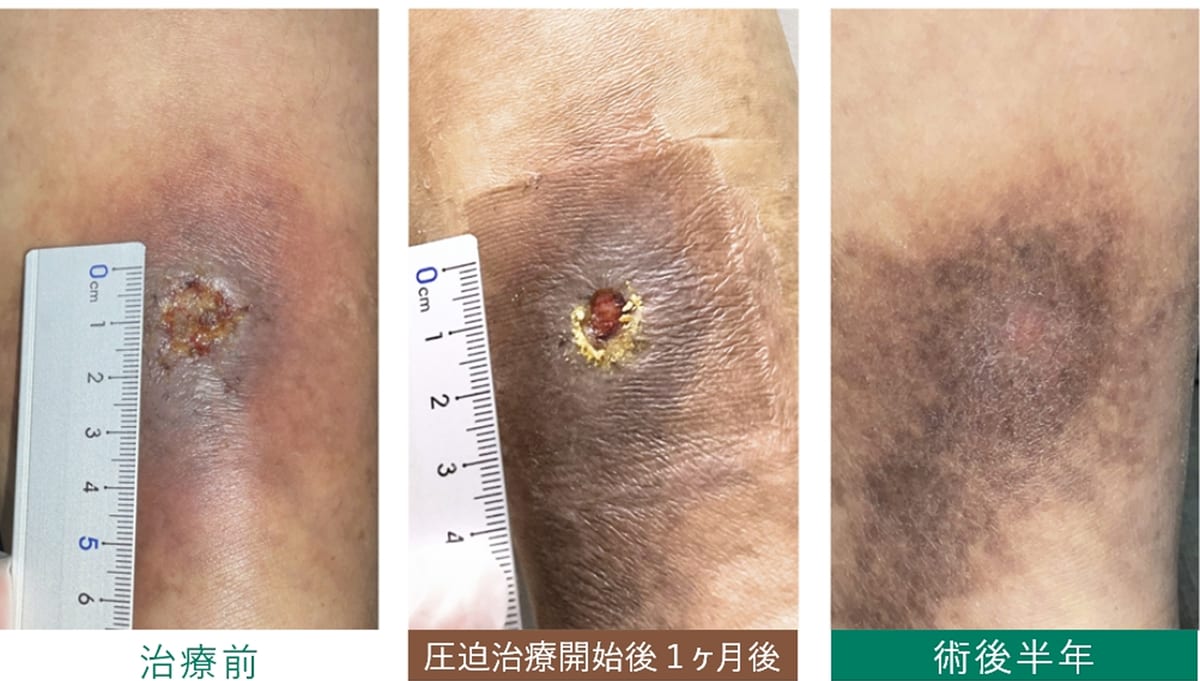 潰瘍 治療経過