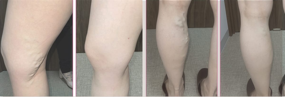 下肢静脈瘤の症例