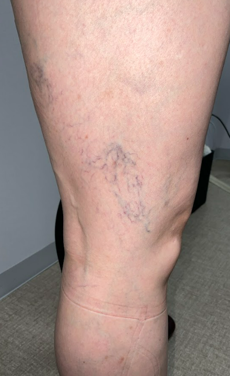 下肢静脈瘤の検査方法を知ろう 2 下肢静脈瘤の検査方法を知ろう