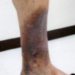 足の皮膚が黒い・皮膚が硬くなる