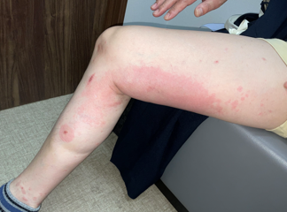 【医療用接着剤による血管内治療について】 2 【医療用接着剤による血管内治療について】