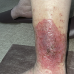 足の湿疹
