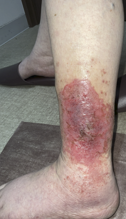 【下肢静脈瘤を放っておくとどうなるの？】