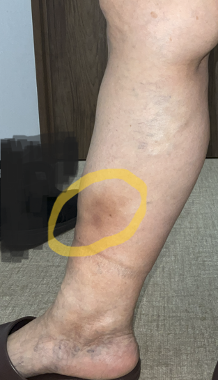 【足のむくみは何科に行けば良い？】