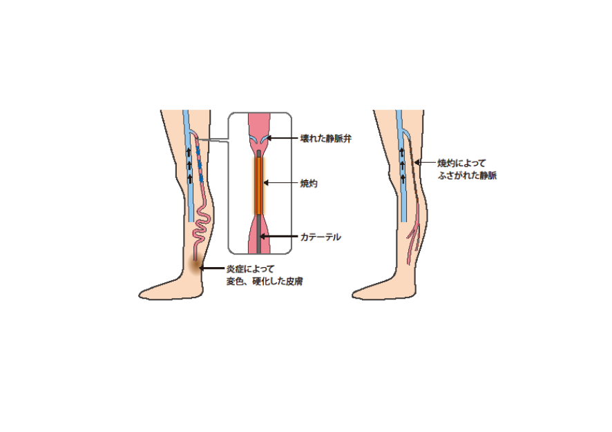 静脈瘤ストリッピング後はどうなりますか?