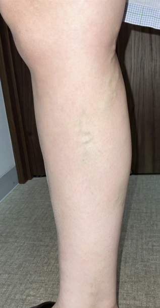 下肢静脈瘤の初期症状とは？治療方法についてご紹介