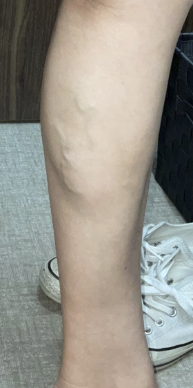 下肢静脈瘤の初期症状とは？治療方法についてご紹介