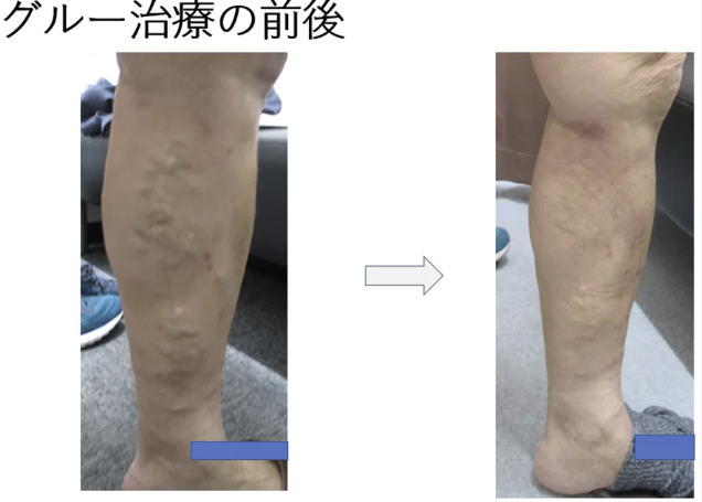 静脈瘤のグルー治療とは？治療内容を詳しく解説