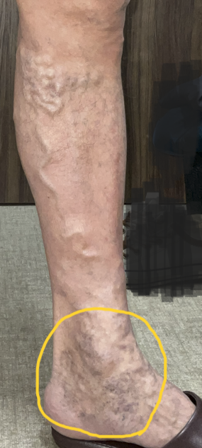 細絡(さいらく)は治療すべき? 1 細絡(さいらく)は治療すべき?