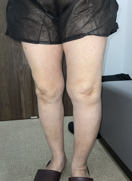 【下肢静脈瘤の初期症状について】 4 【下肢静脈瘤の初期症状について】