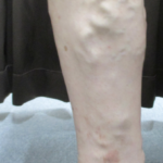 足の血管が浮き出る・ボコボコしている