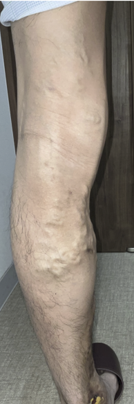 【下肢静脈瘤の初期症状について】 1 【下肢静脈瘤の初期症状について】