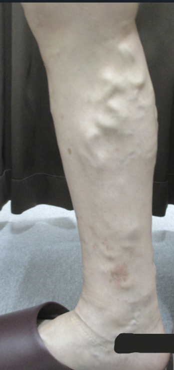 【下肢静脈瘤の初期症状について】