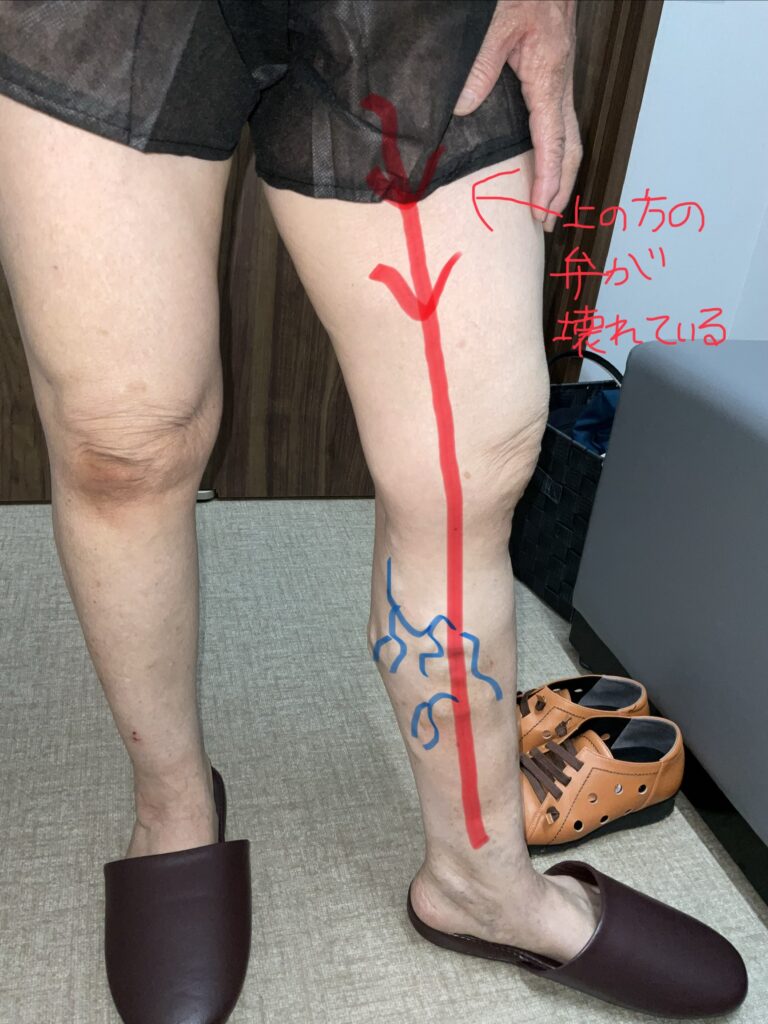 静脈瘤の手術でボコボコ・こぶは消えるのか？【症例写真】
