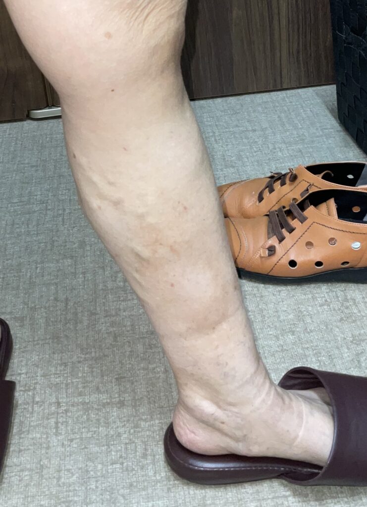 静脈瘤の手術でボコボコ・こぶは消えるのか？【症例写真】