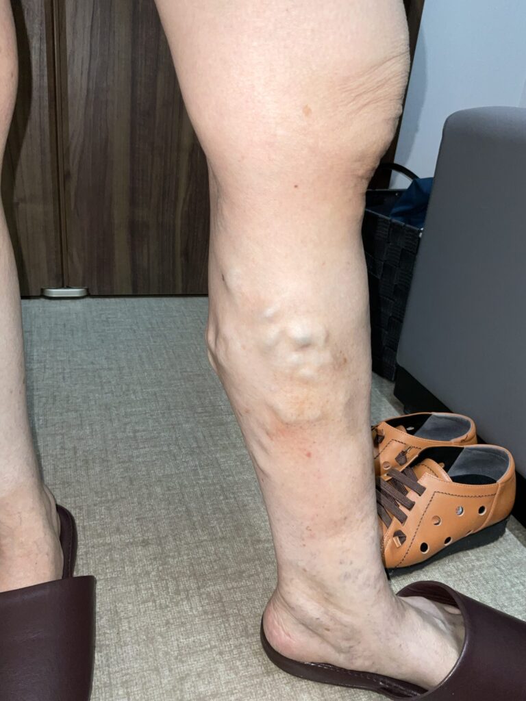 静脈瘤の手術でボコボコ・こぶは消えるのか？【症例写真】